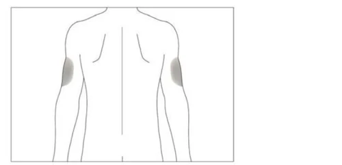 Stylized illustration of the human torso viewed from the back, with two gray areas indicating injection sites on the upper arm muscles