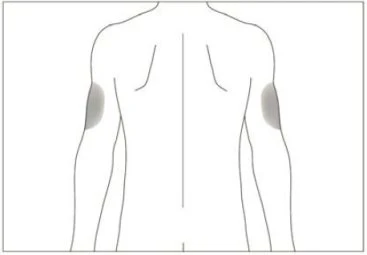 Disegno schematico della schiena di un uomo con due aree grigie circolari che indicano i punti di iniezione sulle braccia superiori