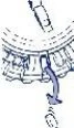 Disegno tecnico che mostra una freccia curva blu che indica il movimento di rimozione di un componente da un dispositivo medico circolare dentellato