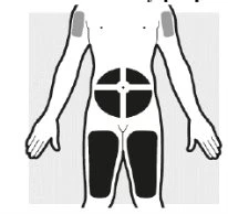 Diagramma del corpo umano che indica le zone di applicazione del farmaco sull'addome e sulle cosce tramite aree nere evidenziate