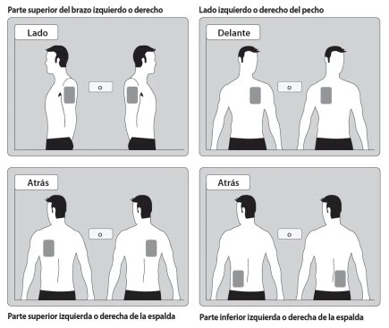 Diagramma medico con quattro riquadri che mostrano i siti di iniezione su braccio, petto e schiena in vista laterale, frontale e posteriore