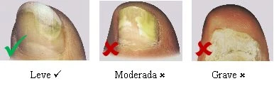 Three nail details with varying severity of infection: mild with green checkmark, moderate and severe with red crosses