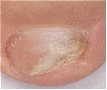 Close-up of a circular skin lesion with irregular borders and a lighter-colored, crusted center on pinkish skin