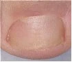 Close-up of a clear skin area with a circular, depressed lesion with a yellowish center and slightly reddened borders