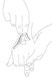 Black line drawing showing two hands manipulating the skin of a wrist to prepare a site for medical injection or blood draw