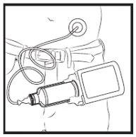 Line drawing of a medical device with monitor and cable connected to a sensor applied to a person's waist over pants with belt
