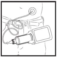 Technical drawing of a medical device with a sensor applied on the