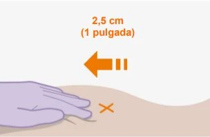 Illustrazione medica con freccia arancione che indica uno spostamento di 2,5 cm e una mano guantata viola su una superficie cutanea con una X arancione