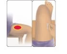Medical illustration showing an inflamed red area on the thigh and a hand applying a white gauze dressing to the same body part
