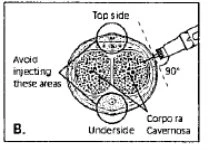 Medical diagram showing a penis with areas to avoid for injection