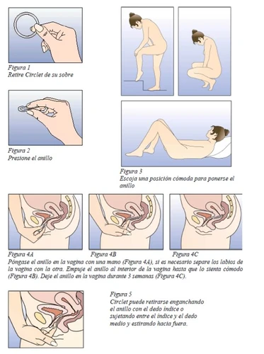 Series of medical illustrations showing how to insert and remove a vaginal ring, with figures of a woman in various positions and anatomical details