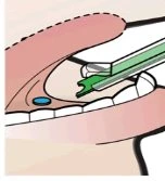Medical diagram showing a green syringe-shaped device being inserted into