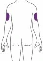 Schema del tronco e delle braccia di una persona vista di spalle con due aree viola rettangolari nella parte superiore di entrambe le braccia