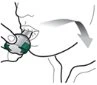 Disegno schematico di una persona che inserisce un dispositivo medico circolare e verde nell'occhio