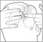 Disegno in bianco e nero che mostra due mani che premono delicatamente la parte superiore della testa e la zona della tempia di una persona