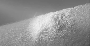 Primo piano in bianco e nero di una zona di pelle con una protuberanza bianca e granulosa che indica un