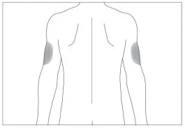 Schematic drawing of a person's torso viewed from the back, with two gray areas highlighted on the upper outer parts of the arms