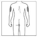 Schematic drawing of a man's torso viewed from the back, with two gray areas indicating injection sites on the upper arms