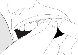 Black and white drawing showing a hand gently lifting the upper lip to expose the teeth and open mouth