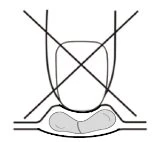 Medical diagram with a large black cross over a cross-section showing an object pressing on soft tissue and internal organs