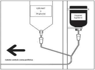 Schema di infusione con due sacche, una di NaCl 0,9% o glucosio al 5% e una di Foscarnet 6 g/250 ml, collegati a un catetere centrale o a una vena periferica