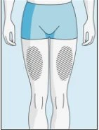 Diagram of a human body standing wearing light blue shorts with two oval hatched areas on the thighs indicating application zones