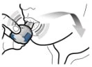 A hand holding a spherical blue medical device near a person's mouth, with an arrow indicating movement toward the