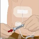 Человек держит шприц, чтобы присоединить его к устройству, прикрепленному к