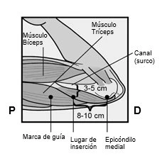 Anatomical diagram of the arm indicating the biceps muscle, triceps, canal, and