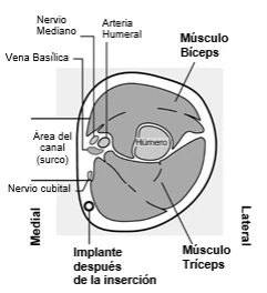 Anatomical diagram of the arm cross-section showing the median nerve, ulnar artery, basilic vein, biceps and triceps muscles, and humerus