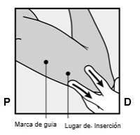 Schematic drawing of an arm with two black dots indicating the guide mark and insertion site for the