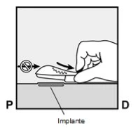 A hand pressing a device over an implant placed on a flat surface with arrows indicating the direction of movement