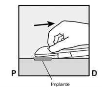 A hand moving a medical device horizontally to the right over an implant positioned on a flat surface