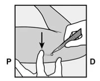 A hand holding an injection pen above the arm skin while the