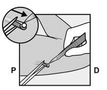Technical drawing showing a hand using tweezers to manipulate a small cylindrical object on a medical surface with magnification
