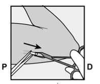 Medical diagram showing a hand holding a syringe for a