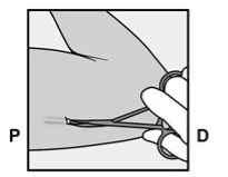 Technical drawing showing a hand gripping forceps to grasp the skin during a medical procedure on a limb with P and D markings
