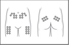 Diagramma medico che mostra tre posizioni per iniezioni sottocutanee sul corpo.