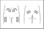 Diagramma medico che mostra i punti di applicazione di cerotti su addome, fianchi, cosce e glutei di un corpo umano stilizzato