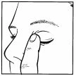Disegno in bianco e nero che mostra un dito che preme delicatamente la palpebra inferiore di un occhio chiuso per somministrare un farmaco