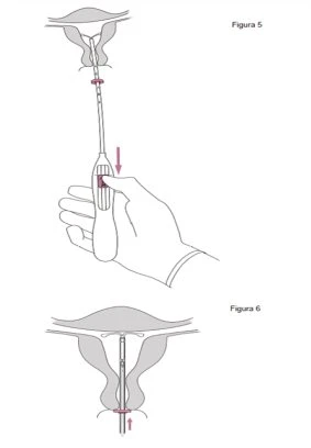 Diagramma medico che mostra l'inserimento di un catetere