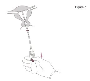 Diagramma medico che mostra una mano che spinge verso il basso un applicatore per inserire un dispositivo all'interno del corpo