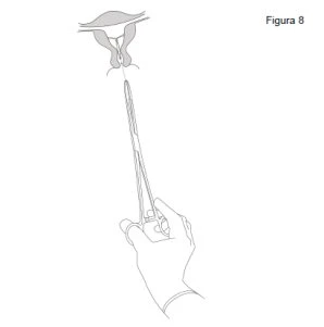 Disegno schematico di una mano che utilizza una pinza per manipolare delicatamente la parte inferiore di un organo anatomico interno