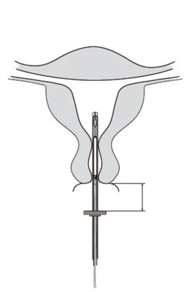 Medical diagram showing a medical device inserted into the vaginal cavity and the