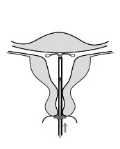 Medical diagram showing an intrauterine device inserted into the