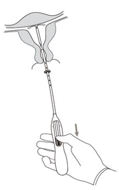 Medical drawing showing a hand holding an applicator to insert an intrauterine device into the