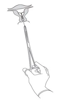 Line drawing of a hand holding a surgical instrument manipulating the lower part of the