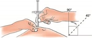 Illustrazione medica che mostra due mani che applicano un'iniezione sottocutanea con l'ago inclinato a 45 gradi rispetto alla pelle