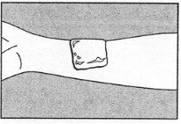 Schematic drawing of an arm with a circle or patch applied to the skin in the middle of the