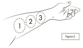 Disegno lineare di un braccio disteso con tre cerchi tratteggiati numerati da 1 a 3 che indicano diverse zone lungo il braccio